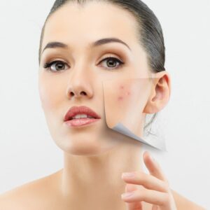 Rosácea - Dermatitis Crónica