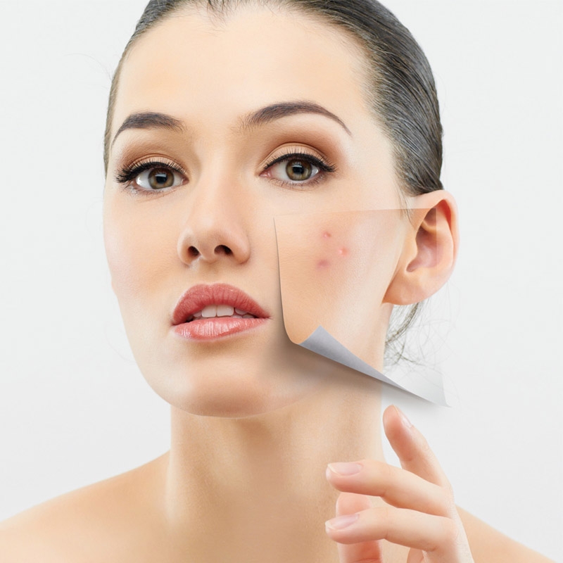 5Rosacea-Dermatitis-Cronica Rosácea - Dermatitis Crónica